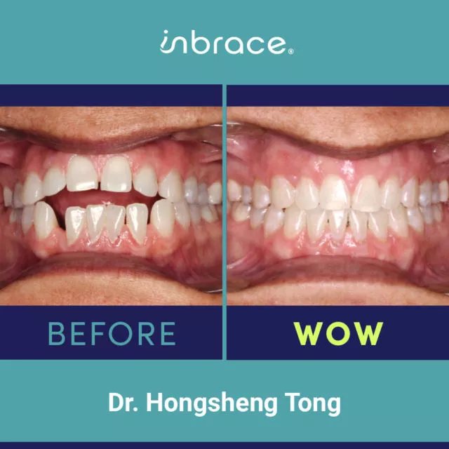 before after compare Dr. Tong